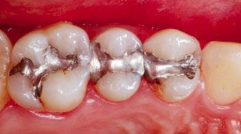 Silver Amalgam Filling